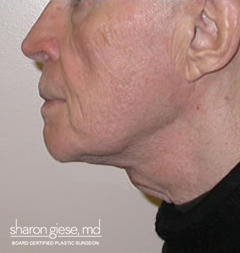 neck lift after picture